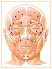 Botox